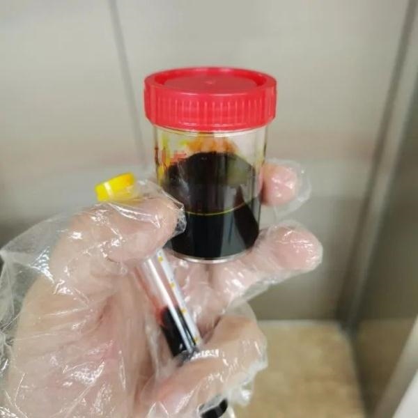 急性肝衰竭！兩兄弟誤吃這種菌 專家提醒
