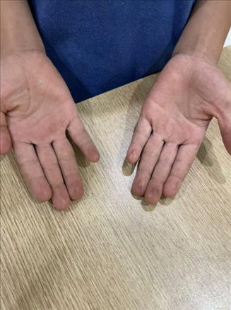 9歲小學(xué)生長(zhǎng)期拍煙卡，手部粗糙長(zhǎng)繭。受訪者供圖